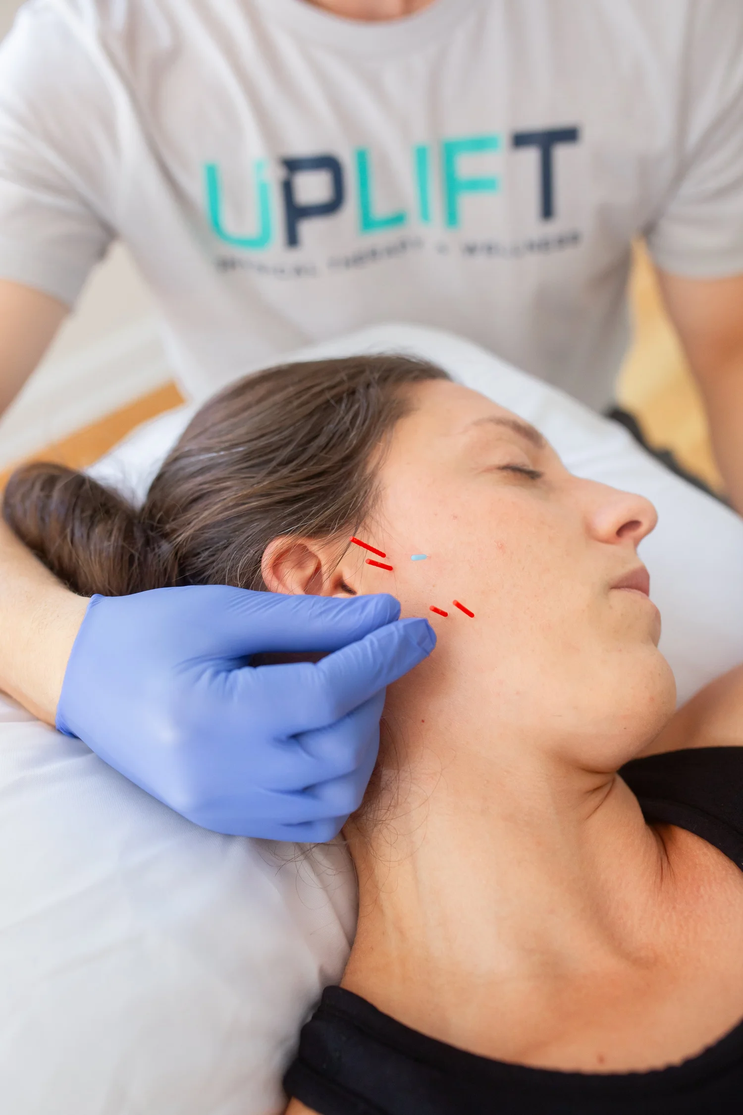 Close-up of a person receiving acupuncture needles on the side of their face near the ear.