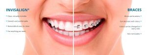 Comparison of Invisalign clear aligners and traditional braces for underbite correction