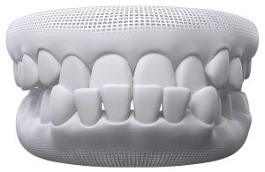 Dental model illustrating an underbite with lower teeth positioned in front of upper teeth