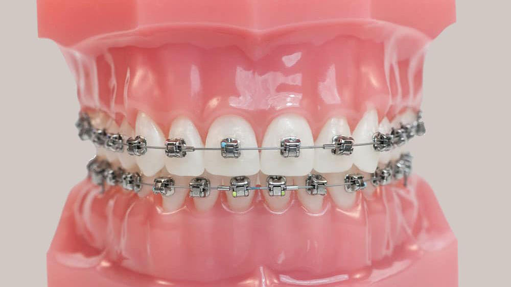 Dental model showing traditional metal braces