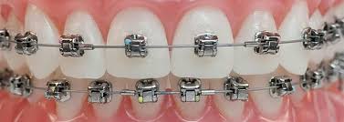 Dental model with traditional metal braces used for crossbite correction