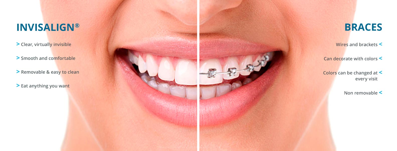 Comparison of Invisalign clear aligners and traditional braces for overbite treatment