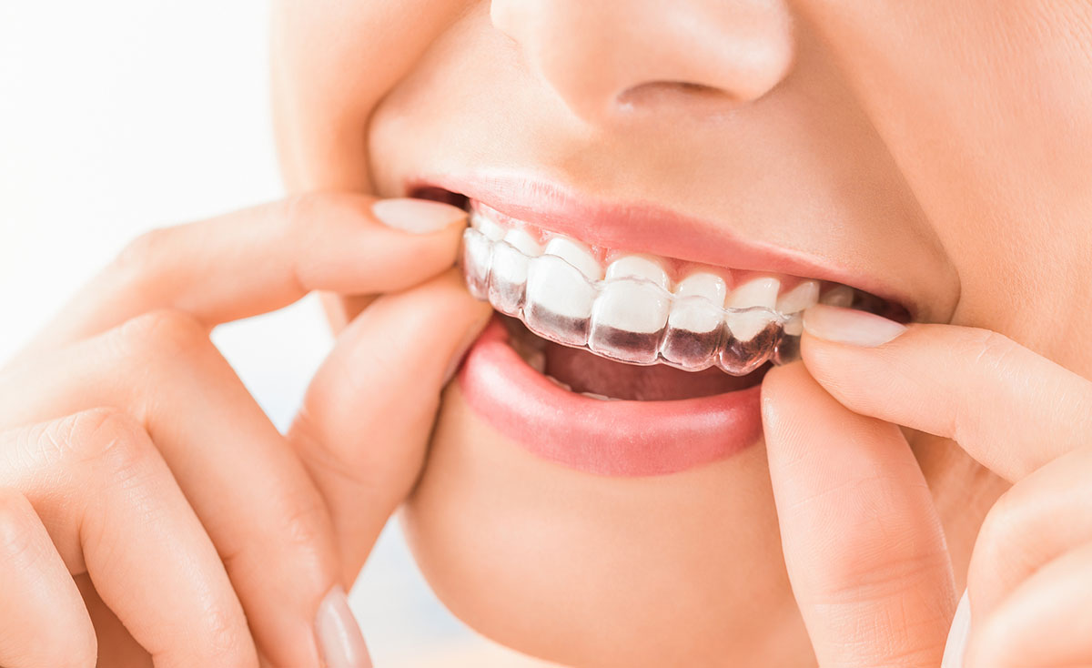 Young woman inserting a clear Invisalign aligner