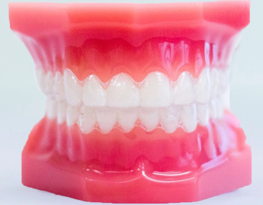 Dental model fitted with clear Invisalign aligners