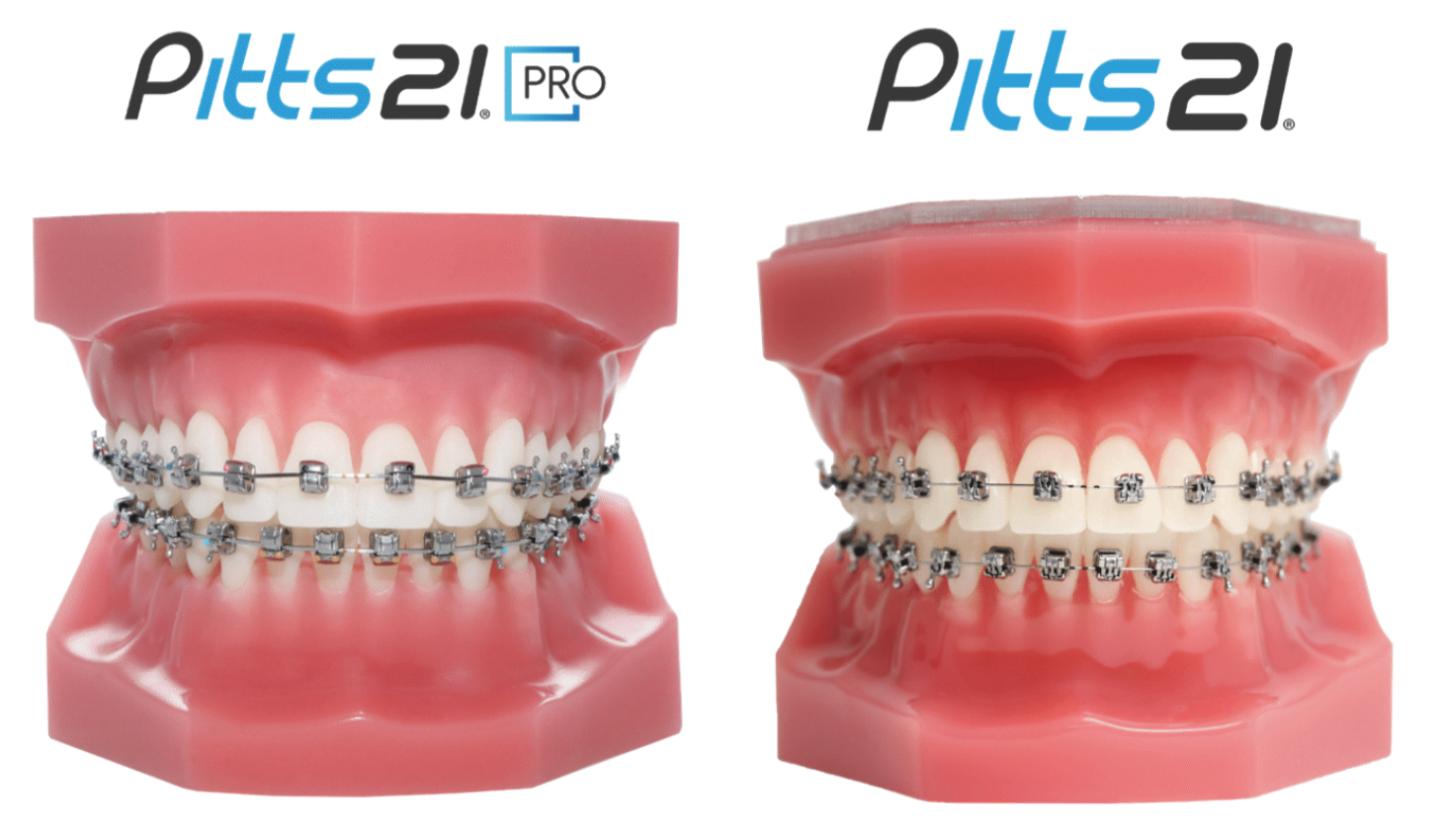 Dental models comparing Pitts21 PRO self-ligating brackets with traditional braces