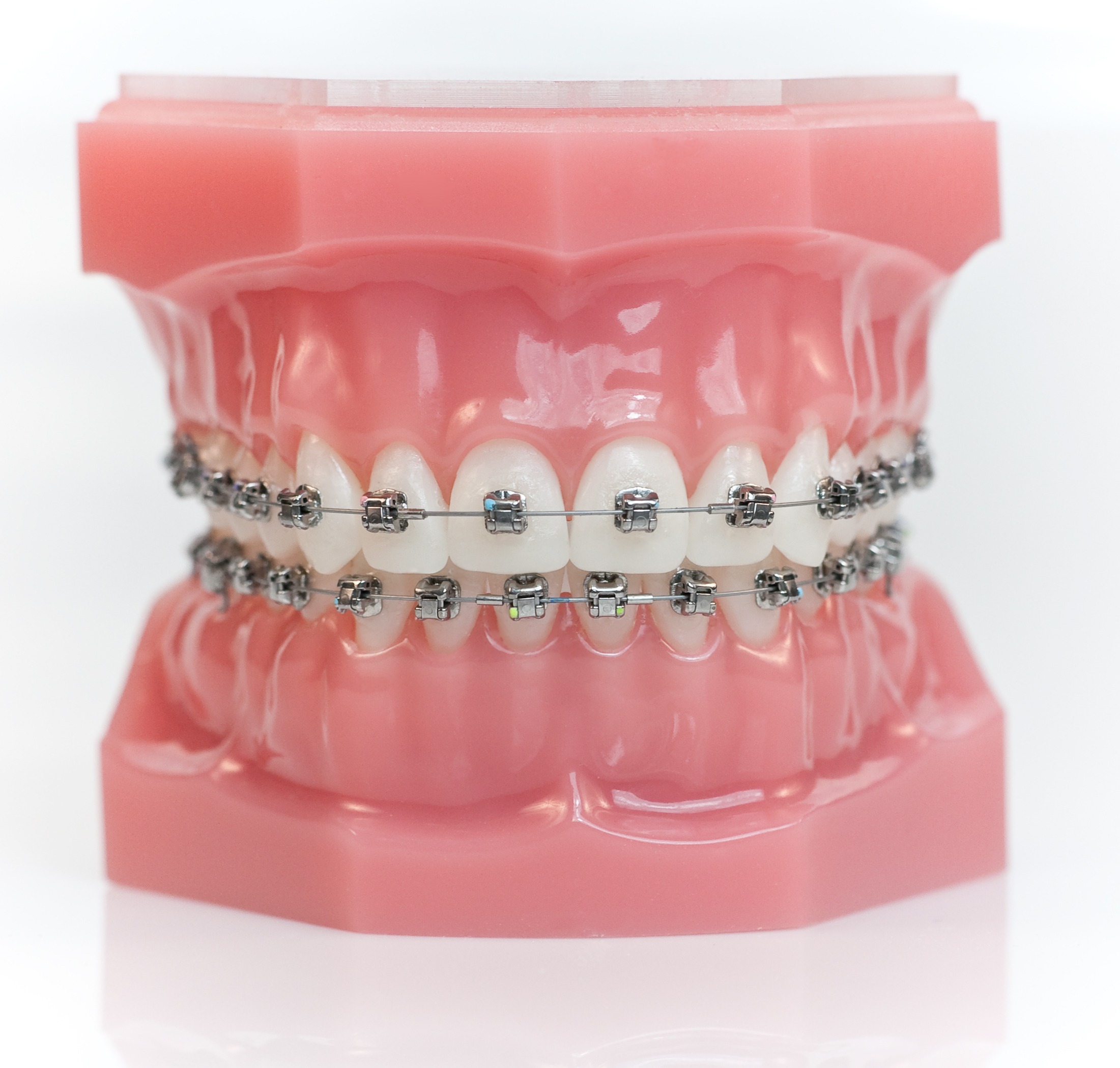 Dental model showing Damon self-ligating braces