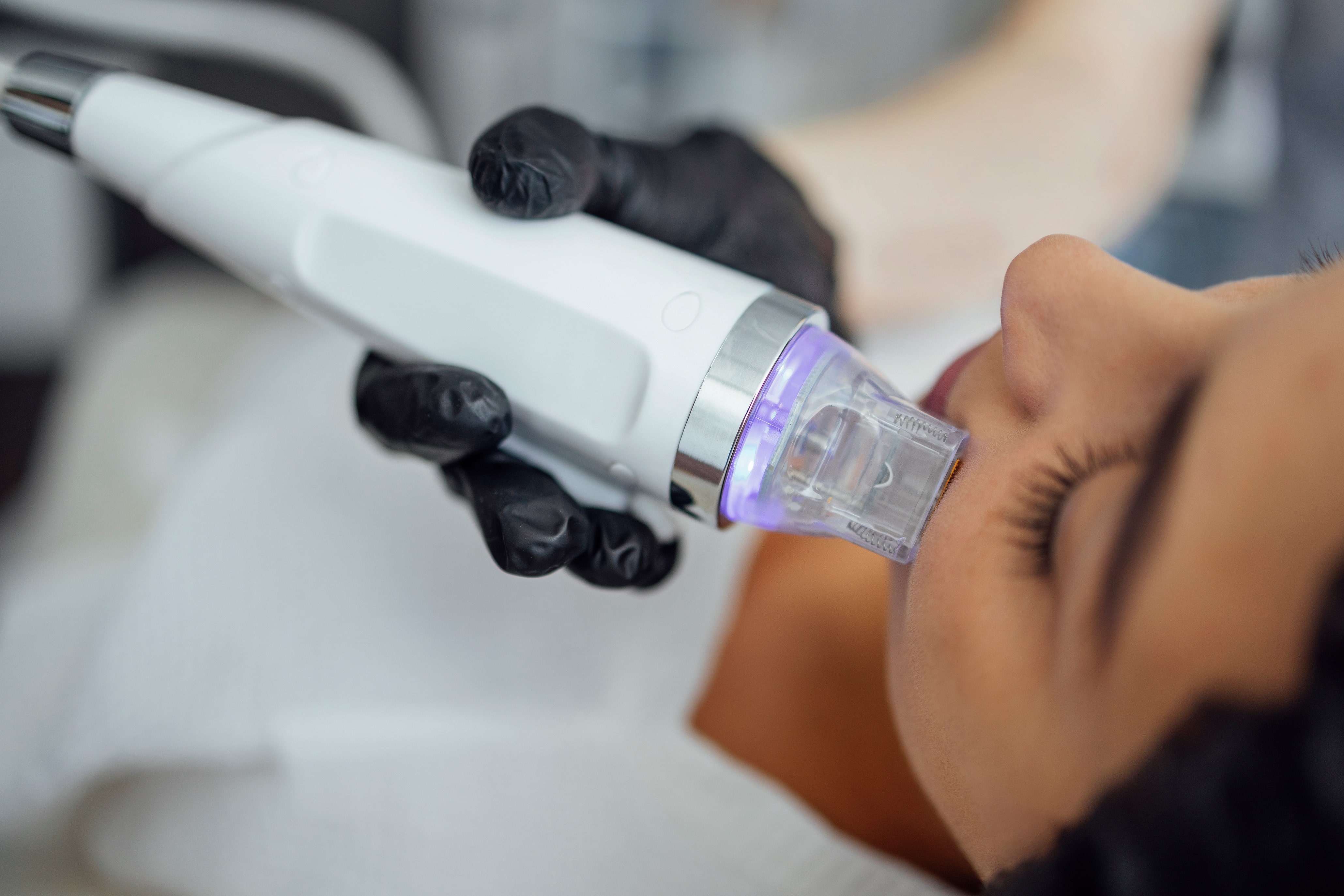 Exion RF Microneedling and hormone therapy for skin in Murray, Utah
