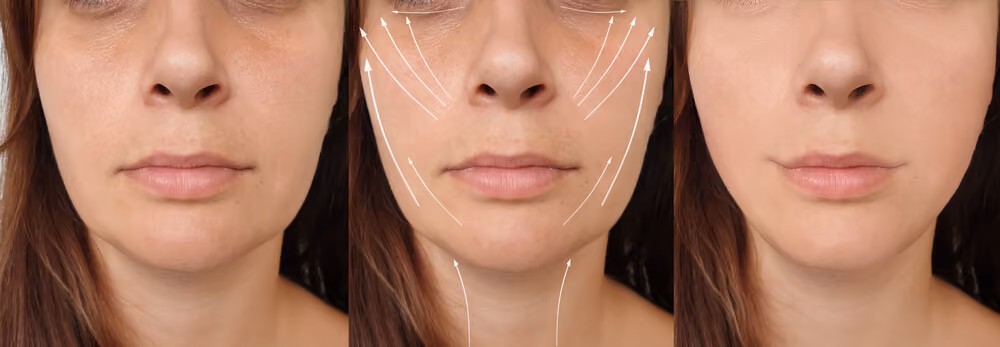 harmonizacao facial exemplo 2