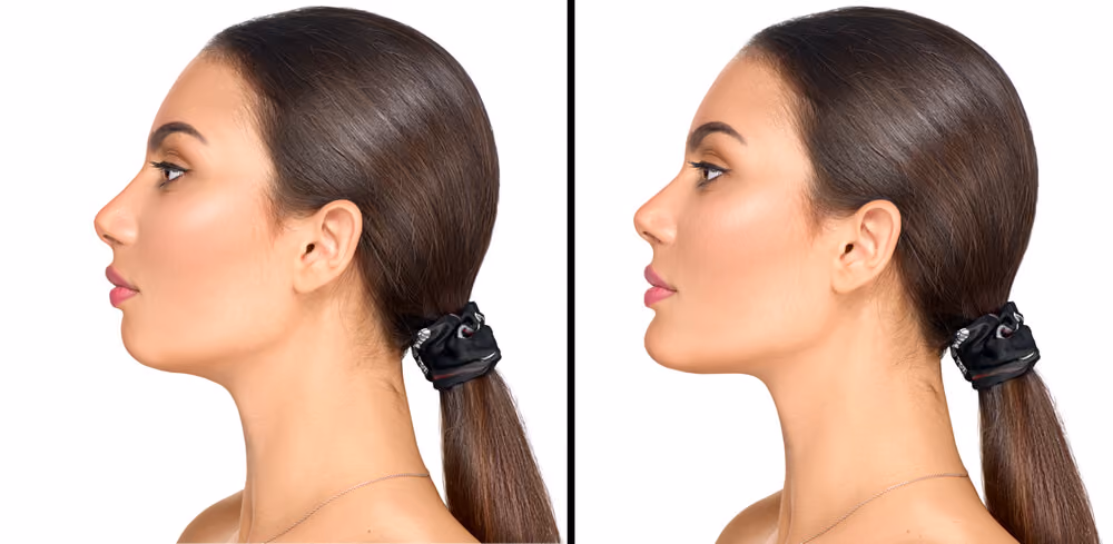 harmonizacao facial exemplo 1