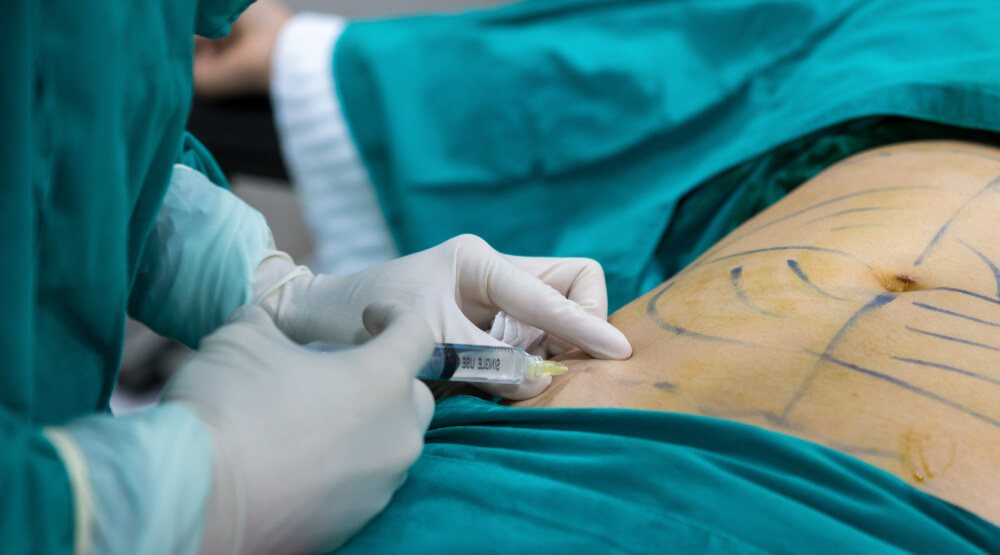 como acontece cirurgia lipoescultura