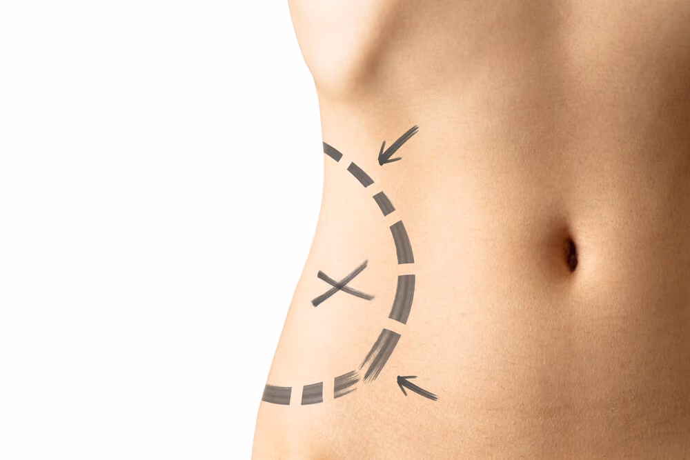 quanto custa lipoescultura