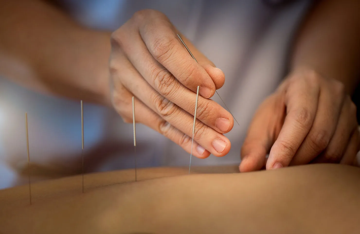 dry needling