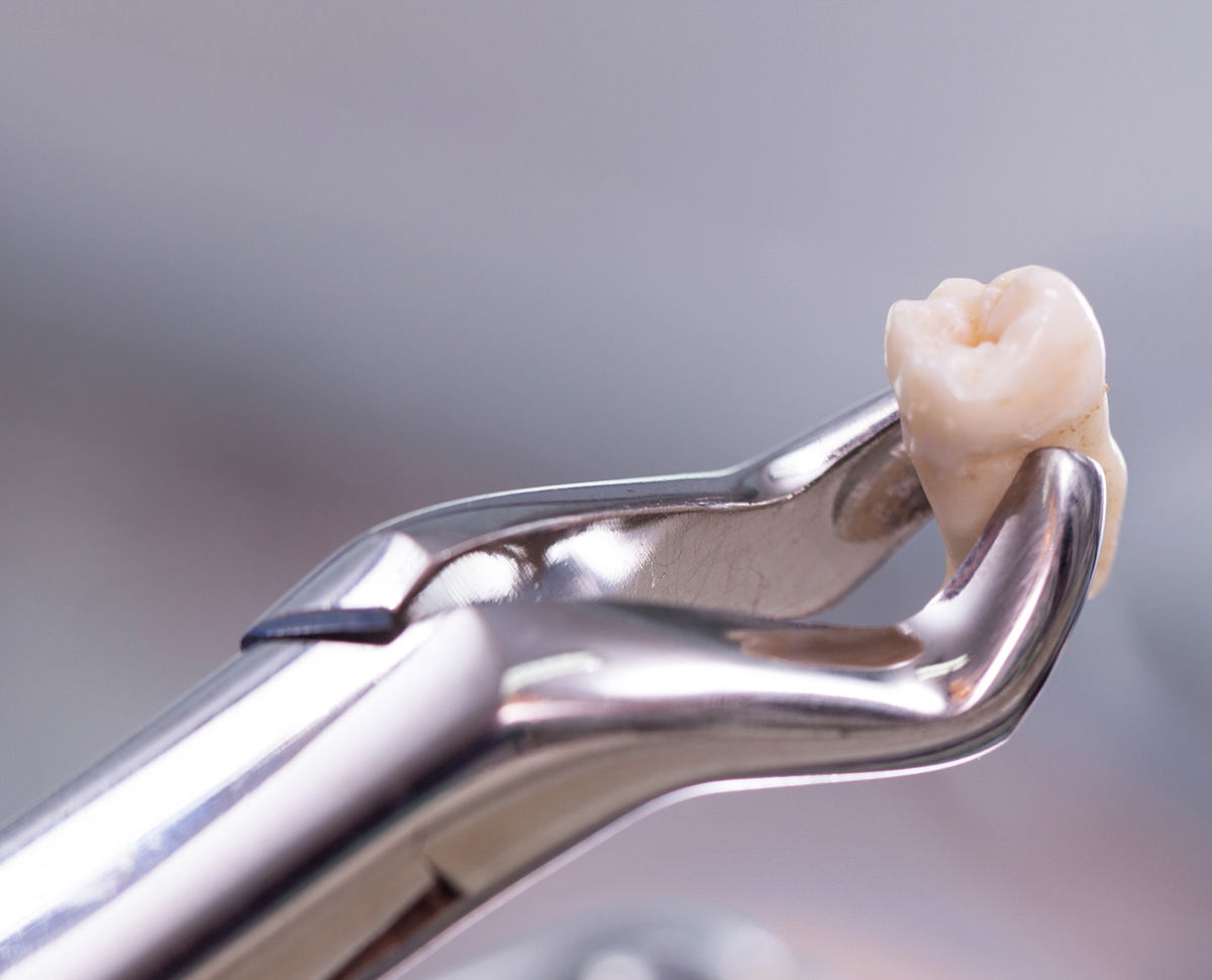 Tooth Extractions | Rai Family Dentistry