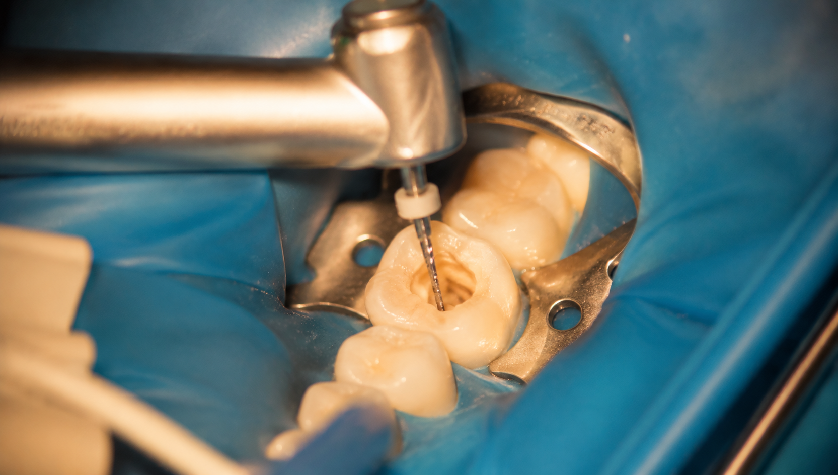 Root Canals | Rai Family Dentistry