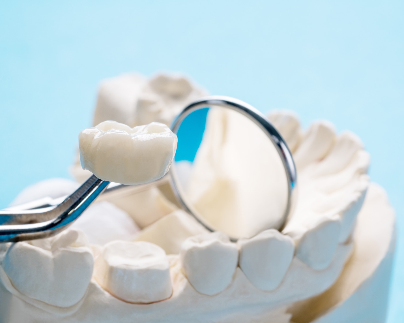 Dental Crowns | Rai Family Dentistry
