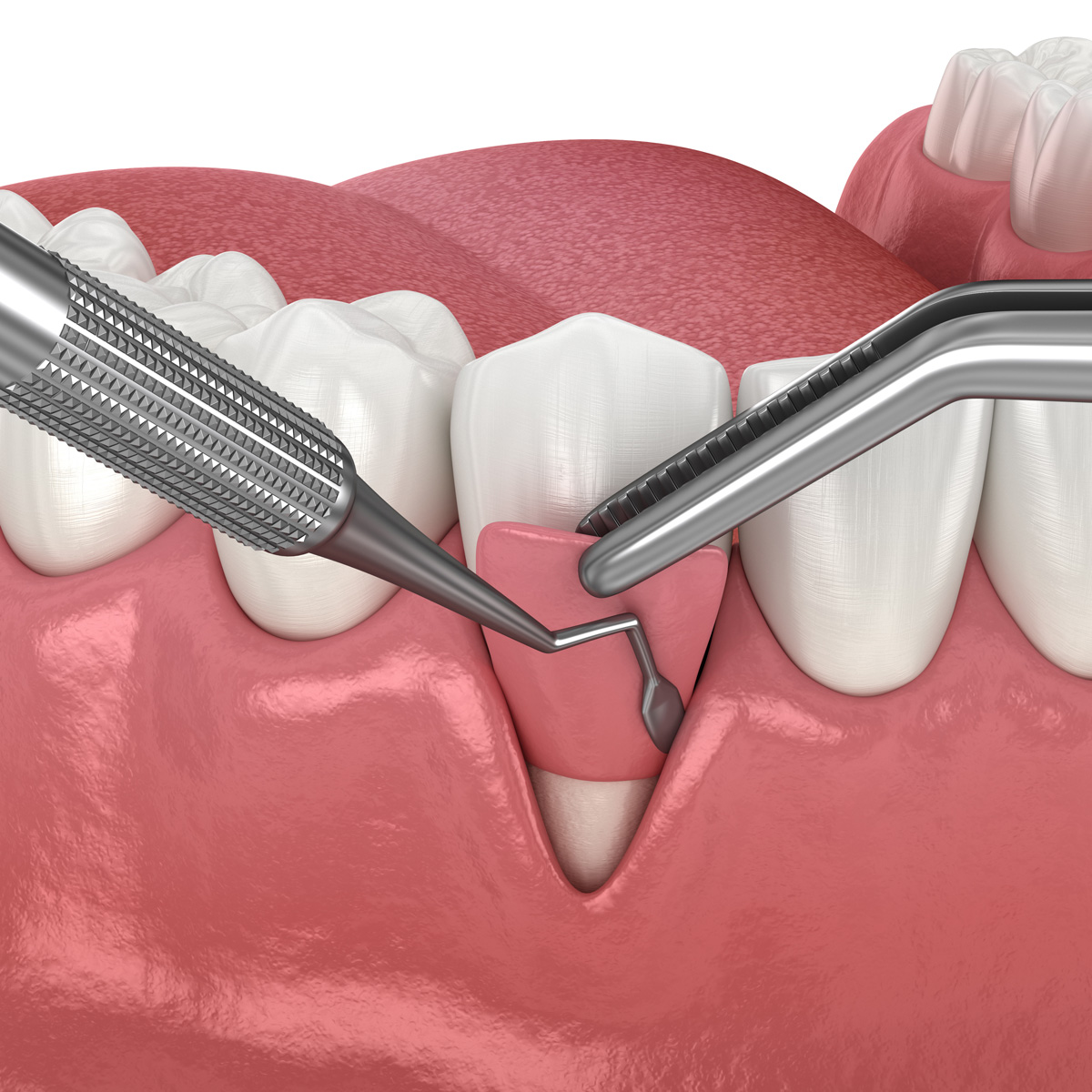 Soft Tissue Grafting | Rai Family Dentistry