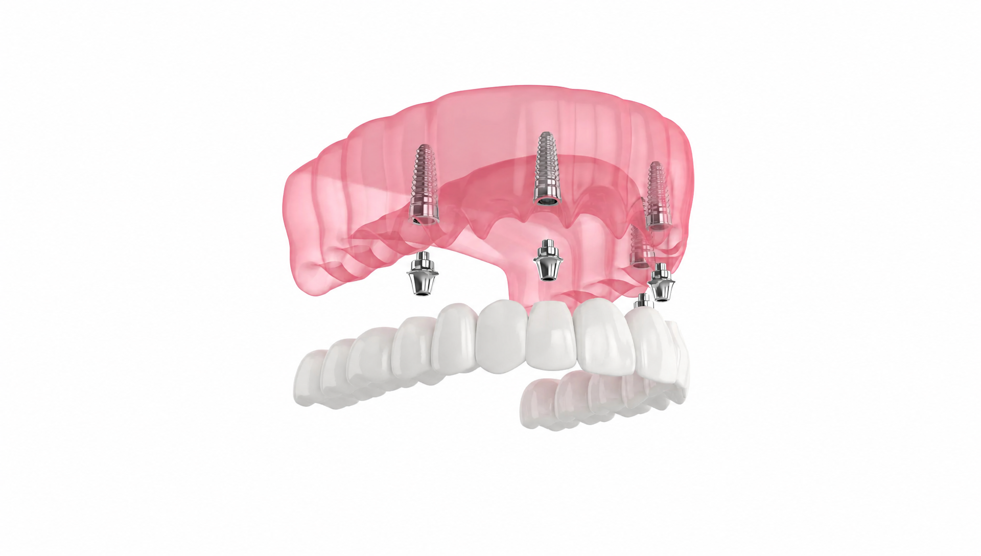 All-on-4 Dental Implants | Rai Family Dentistry