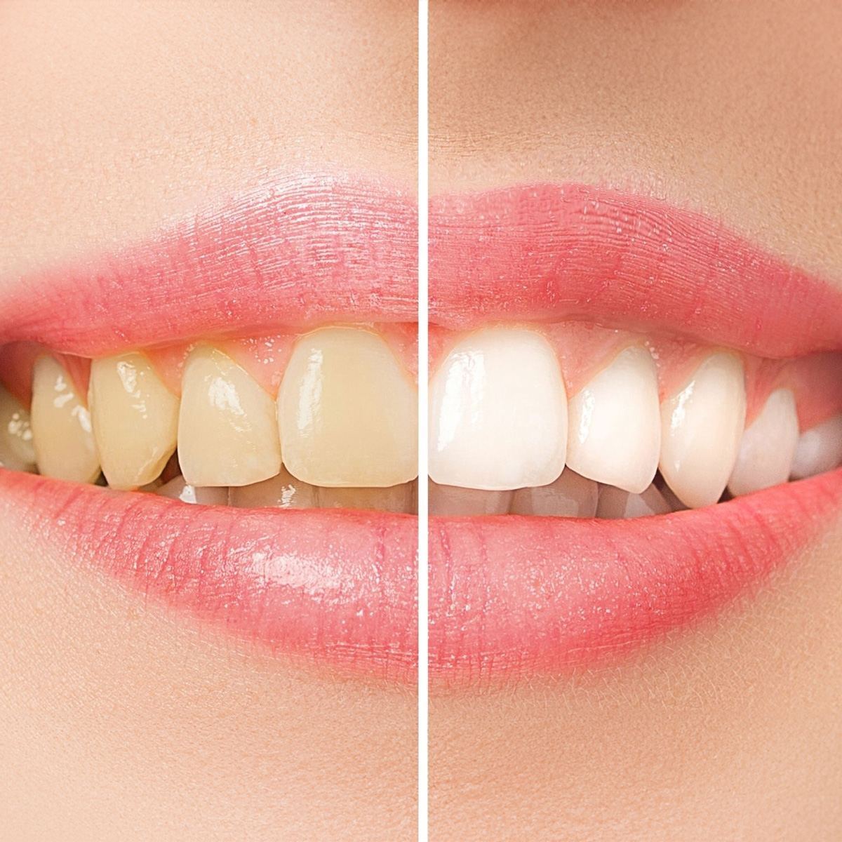 Teeth Whitening | Rai Family Dentistry
