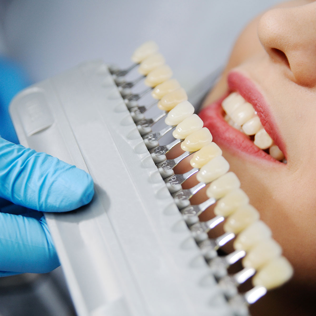 Veneers | Rai Family Dentistry