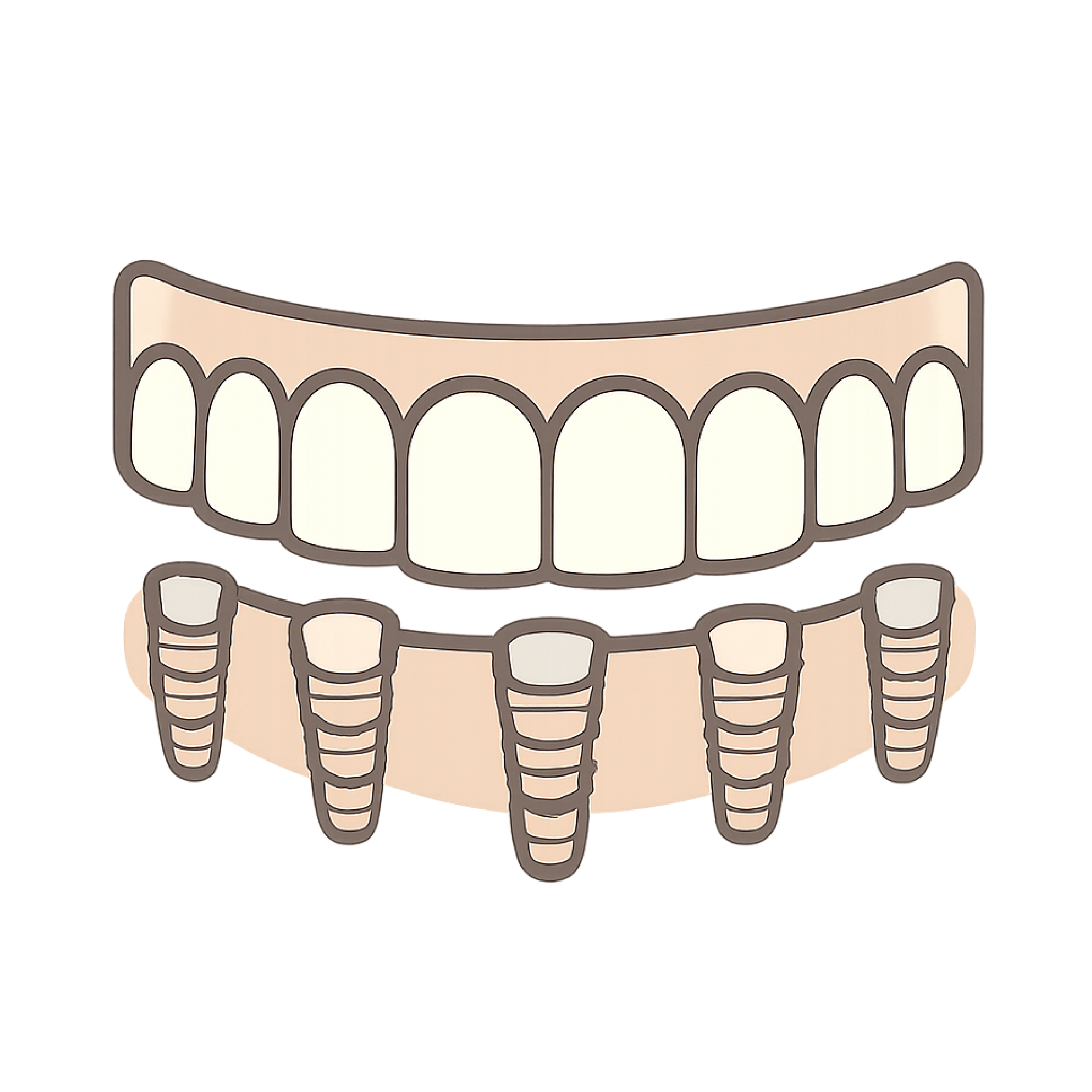 Full Mouth Dental Implants