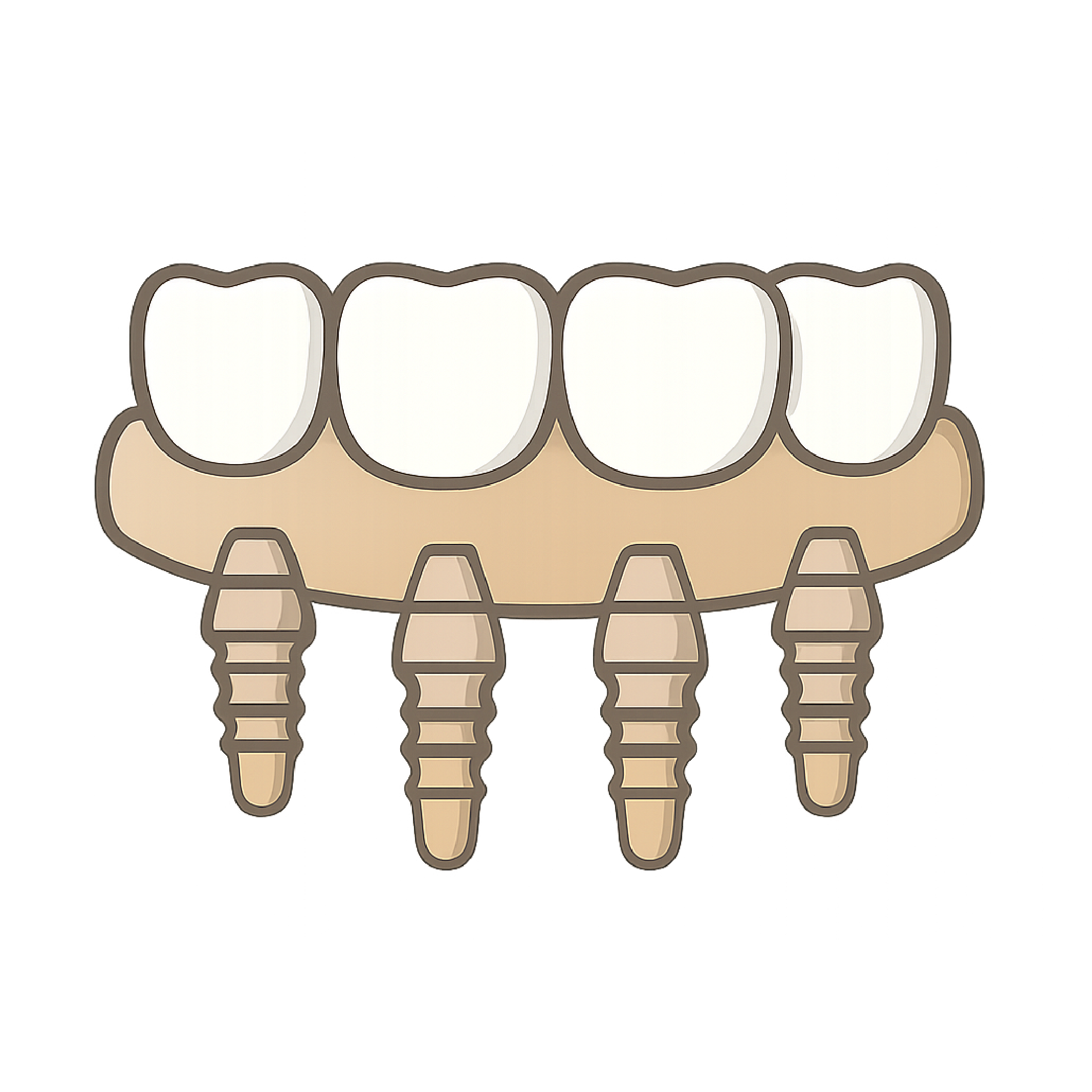 All-on-4 Dental Implants