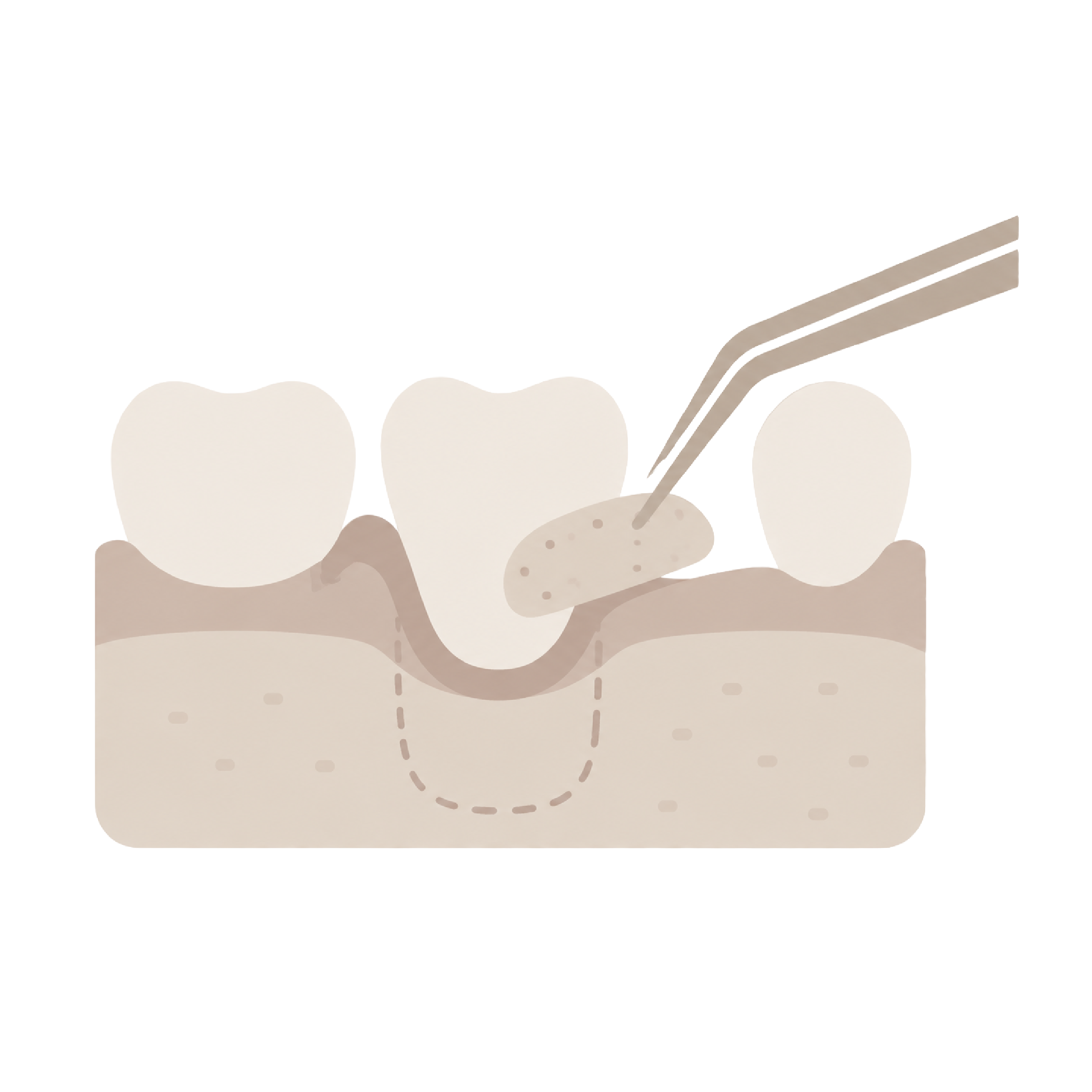 Soft Tissue Grafting