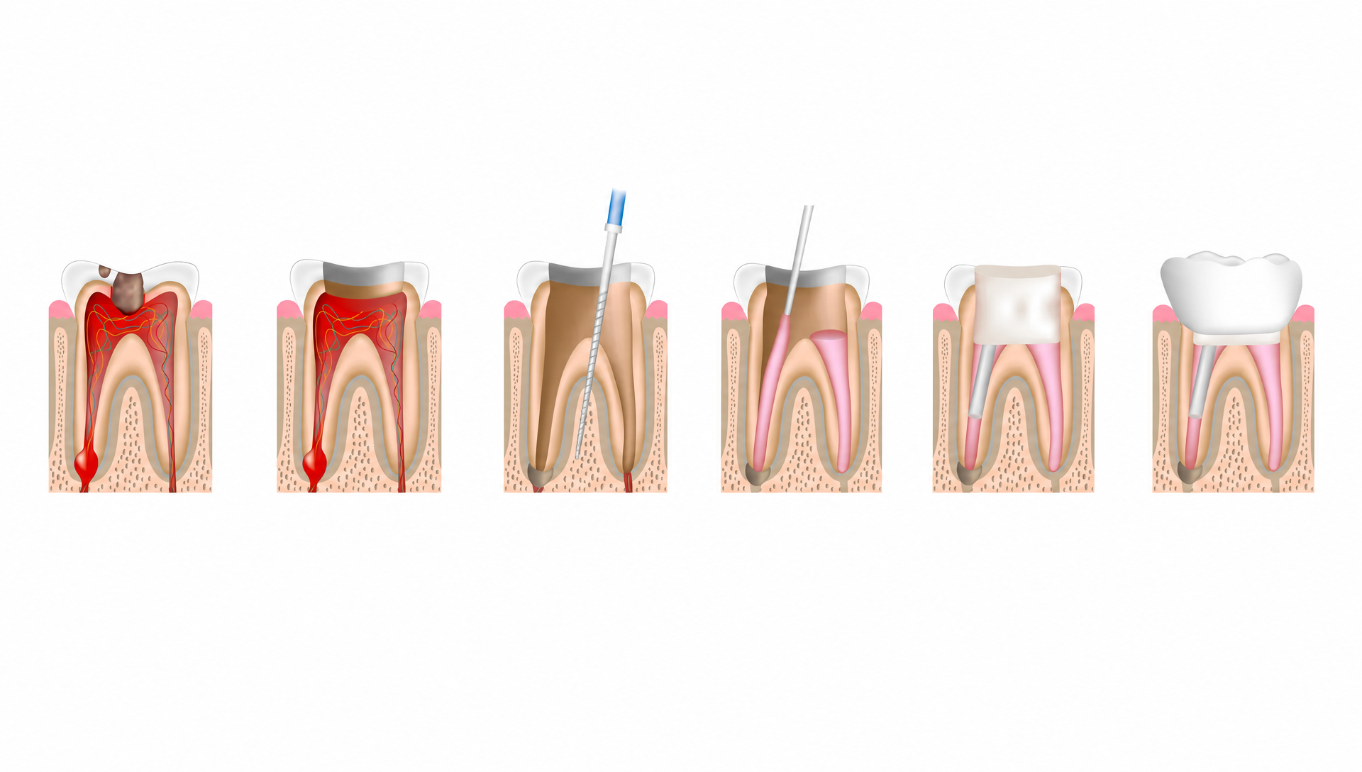Tooth Retreatment | Rai Family Dentistry