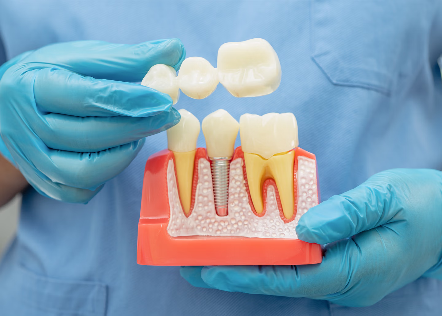 Dental Bridges | Rai Family Dentistry