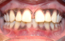 Fastbraces Orthodontic Transformation