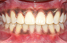 Fastbraces Orthodontic Transformation