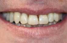 Smile Makeover Transformation