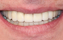 Smile Makeover Transformation
