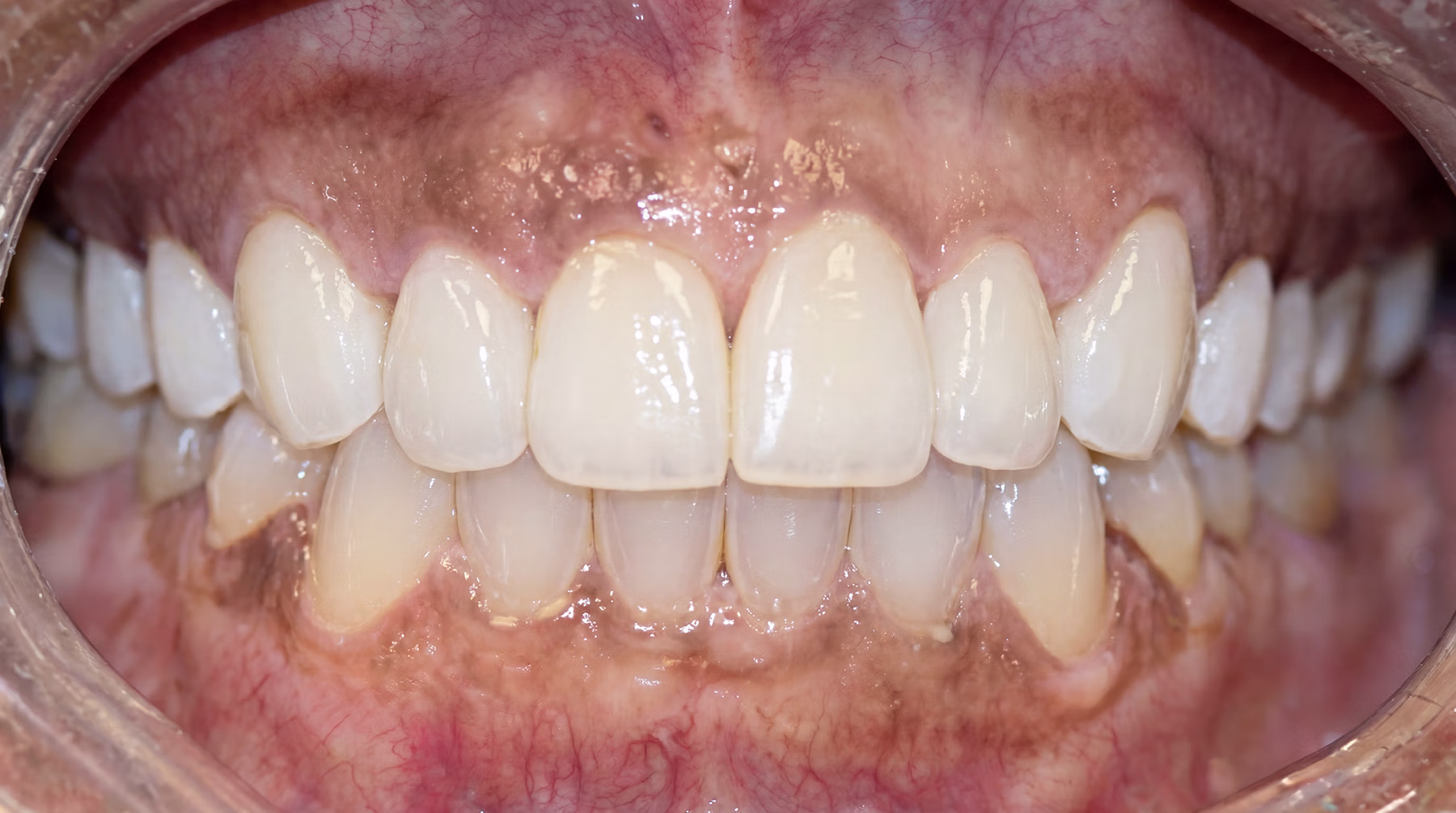 Smile Makeover & Invisalign Transformation