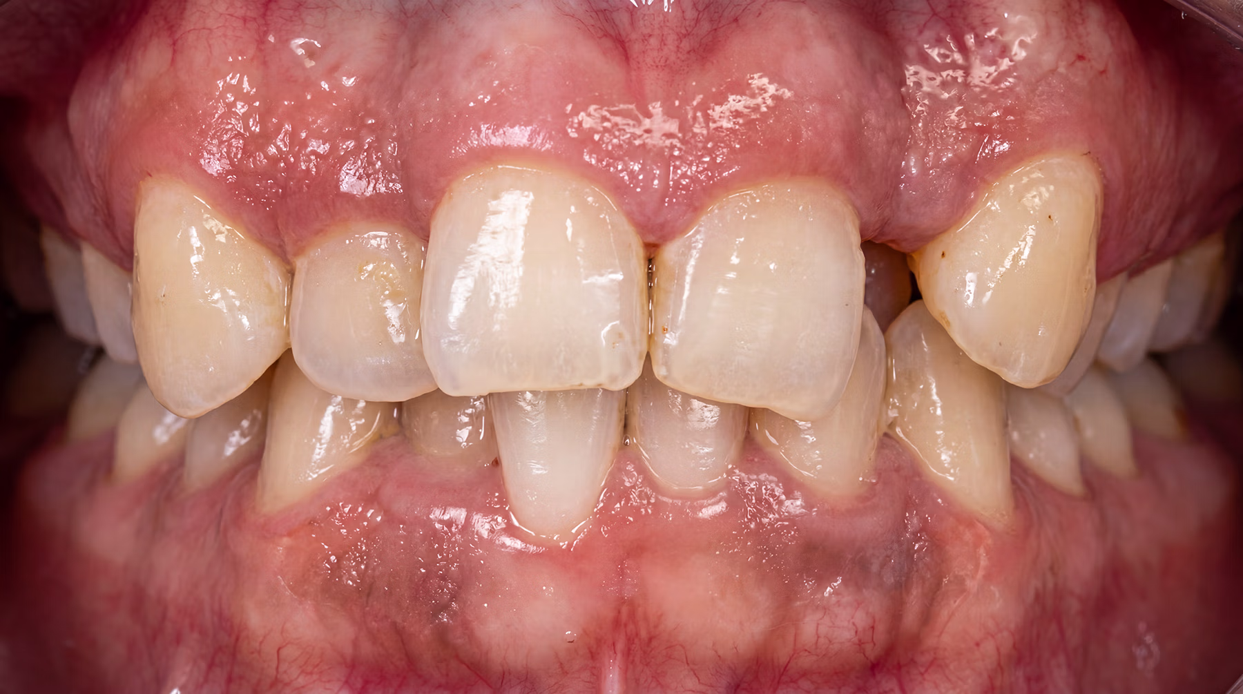 Fastbraces Smile & Bite Correction