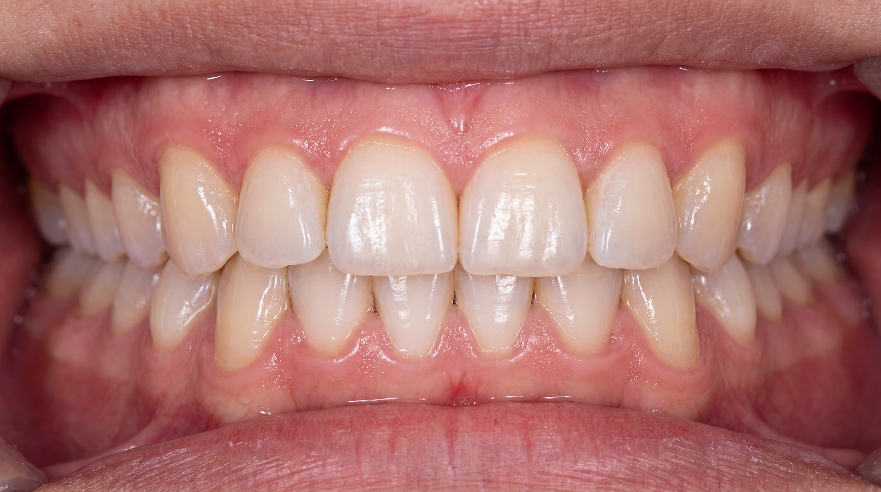Fastbraces Smile & Bite Correction