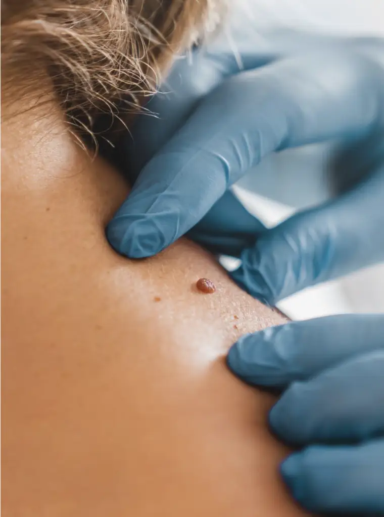 Examen dermatologique d'un grain de beauté au dermatoscope