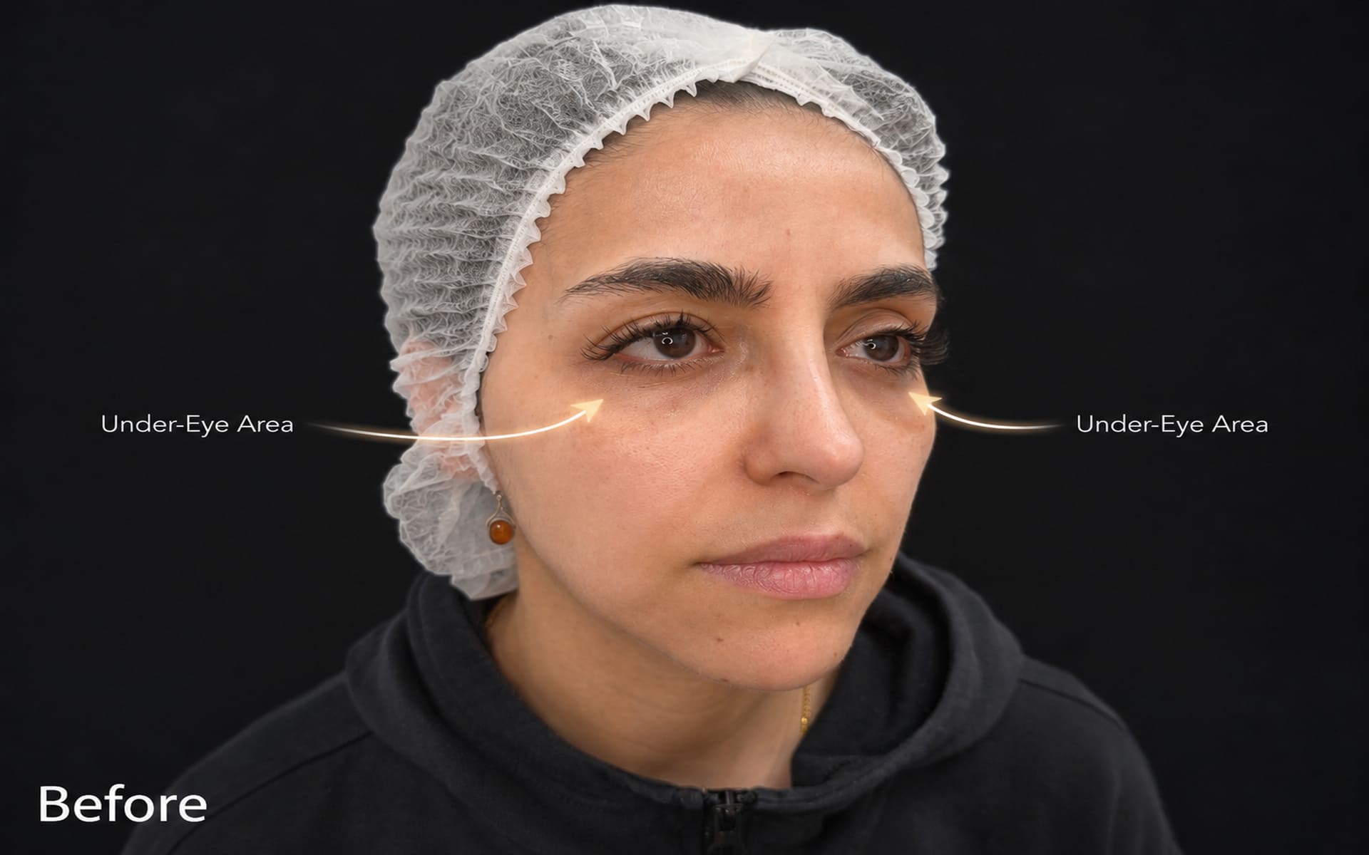Case 2, under-eye area before treatment