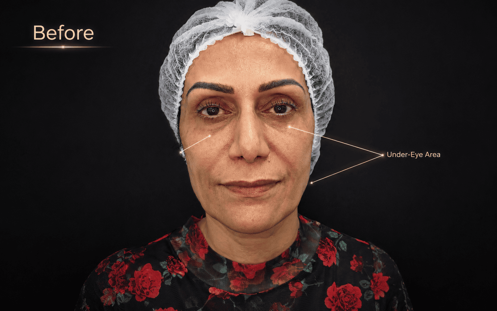 Case 3, under-eye area before treatment