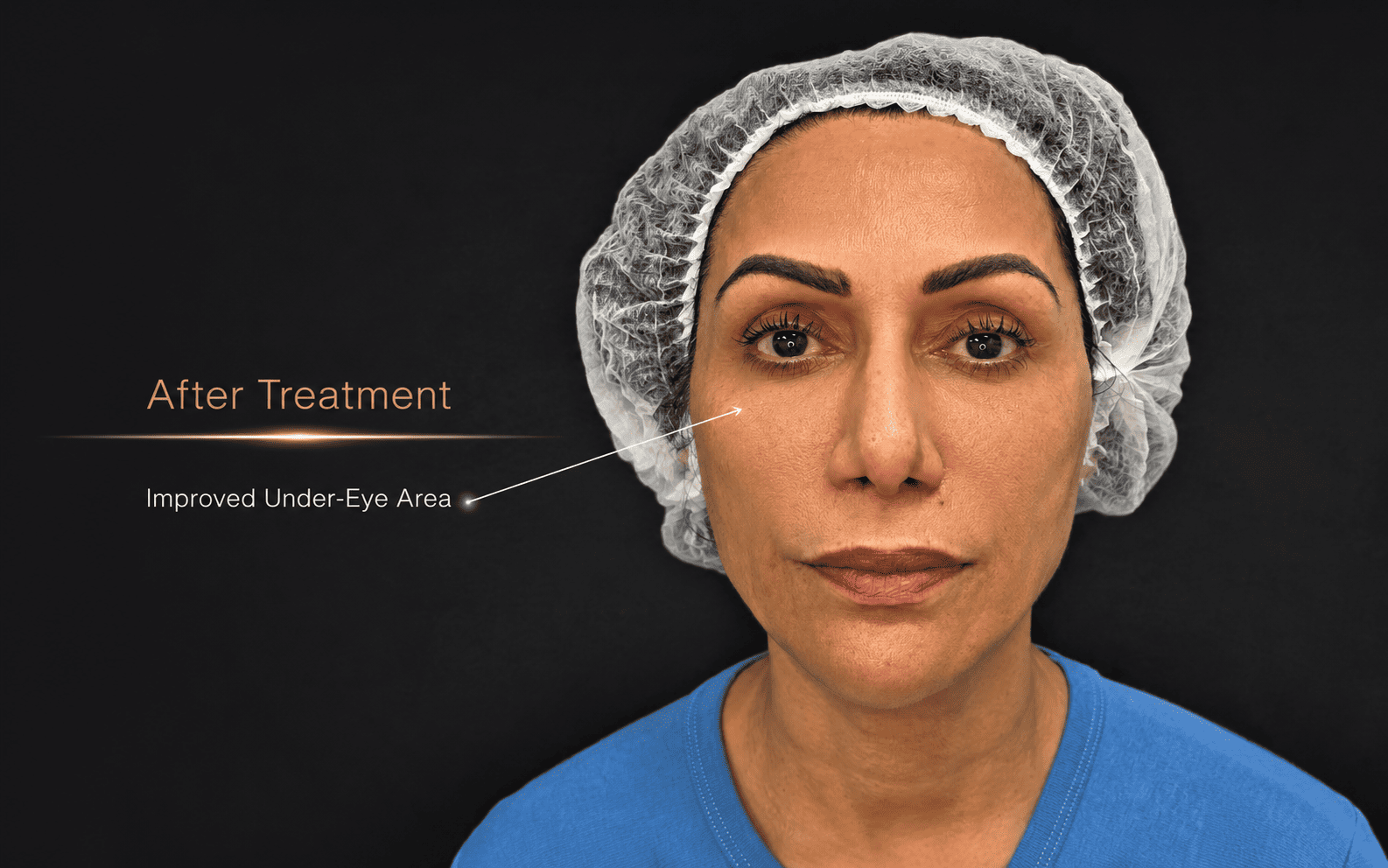 Case 3, under-eye area after treatment
