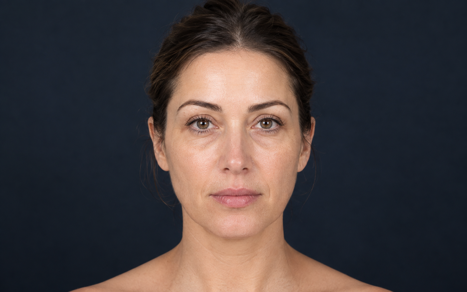Illustrative face after treatment, looking rested with restored mid-face support
