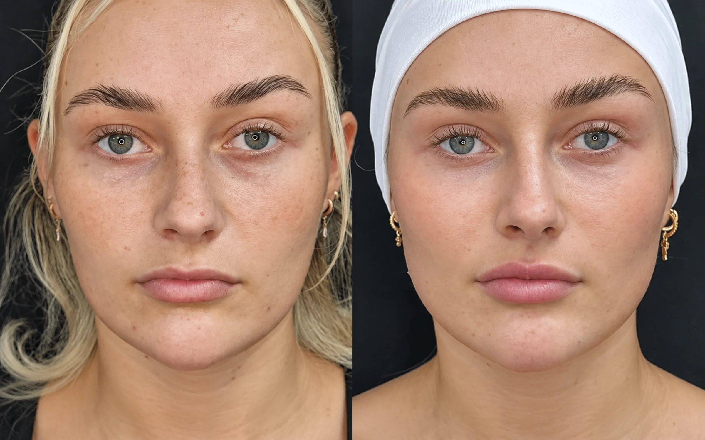 Before and after cheek and midface filler, front view: before treatment on the left and after treatment on the right