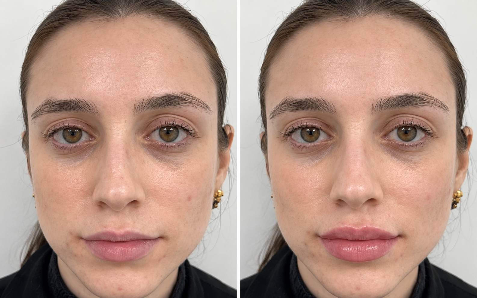 Before and after lip filler, front view: lips before treatment on the left and after treatment on the right