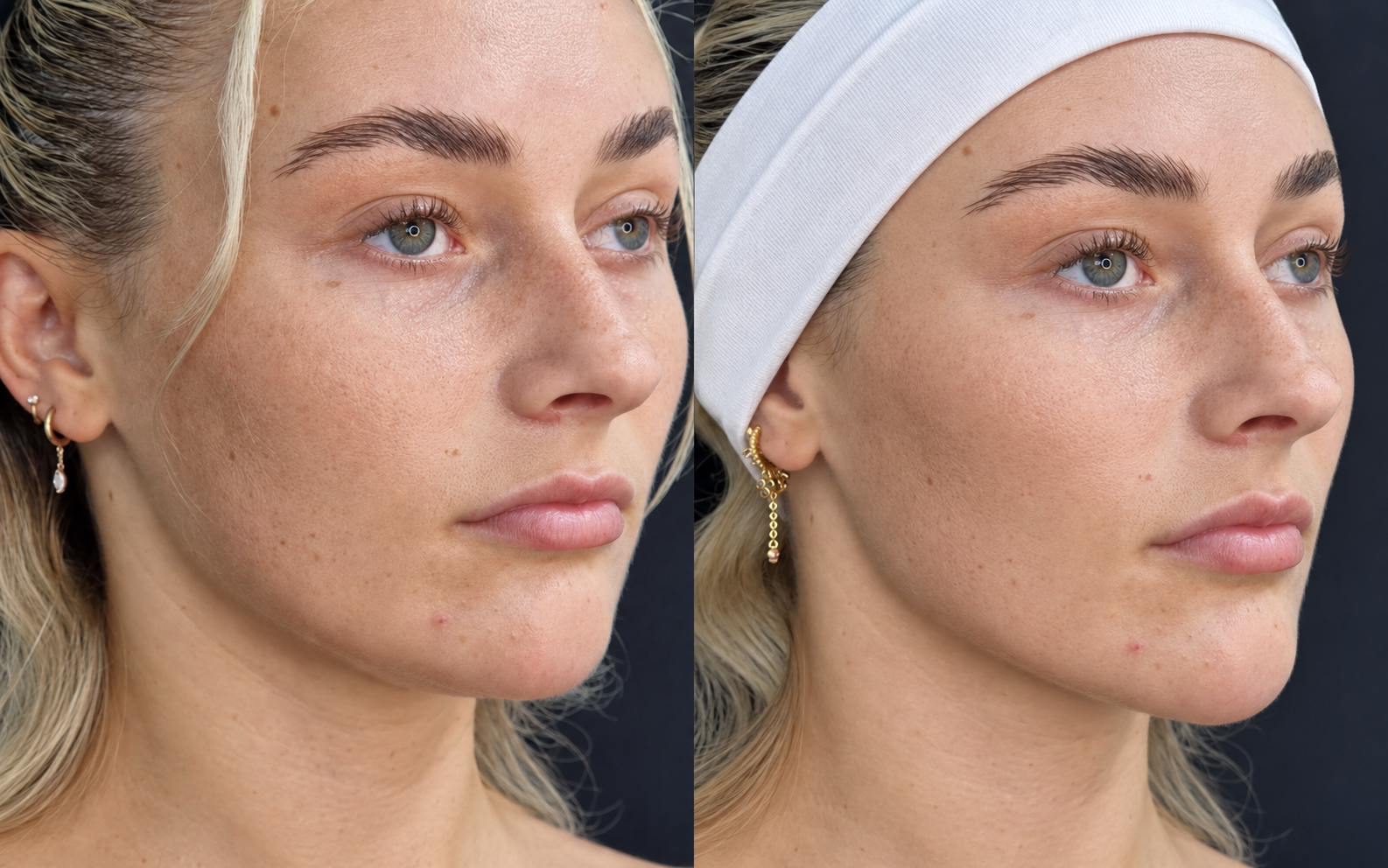 Before and after jawline filler, three-quarter view: before treatment on the left and after treatment on the right