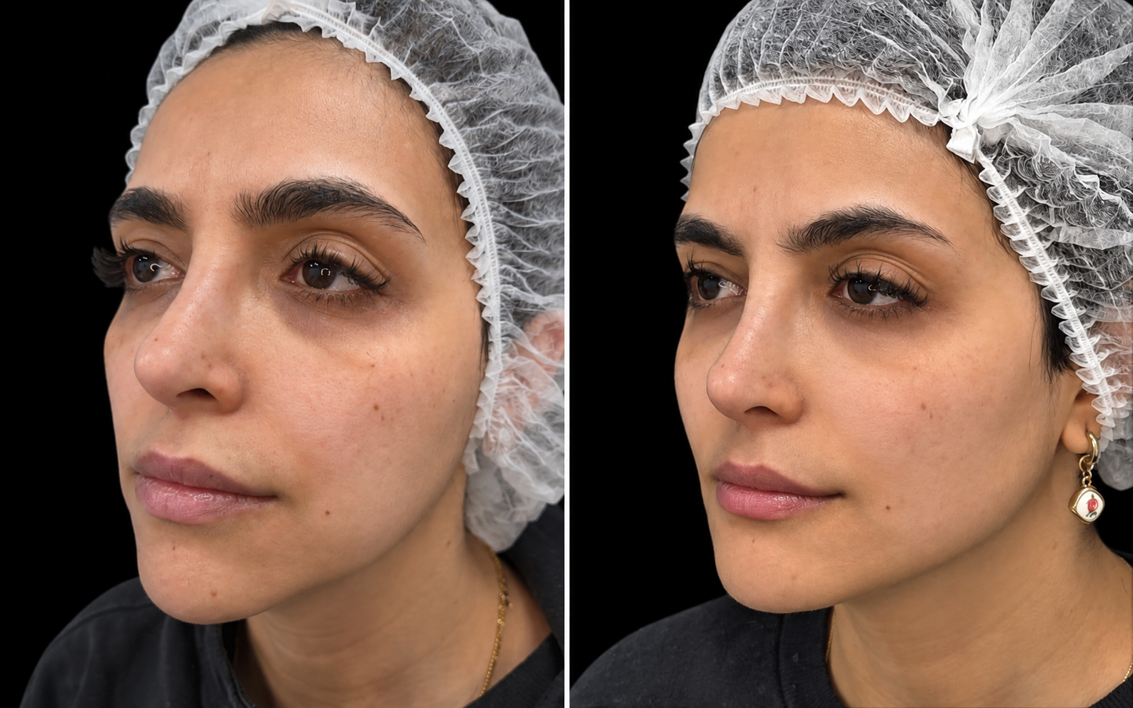 Before and after jawline filler, three-quarter view: before treatment on the left and after treatment on the right