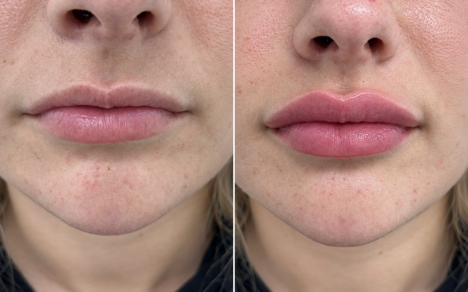 Before and after lip filler, close view of the lips and chin: before treatment on the left and after treatment on the right
