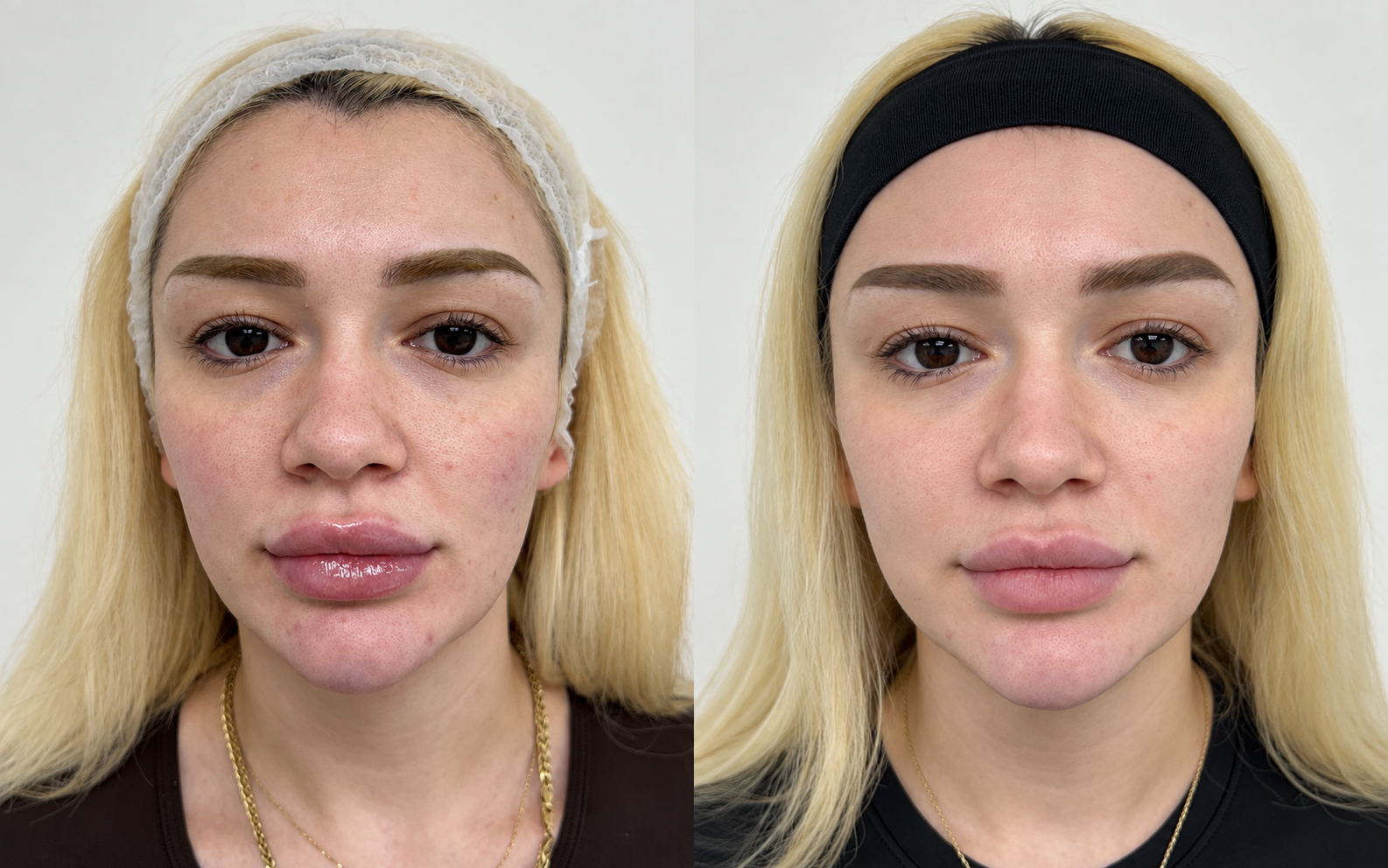 Before and after microneedling, front view: skin before treatment on the left and after treatment on the right