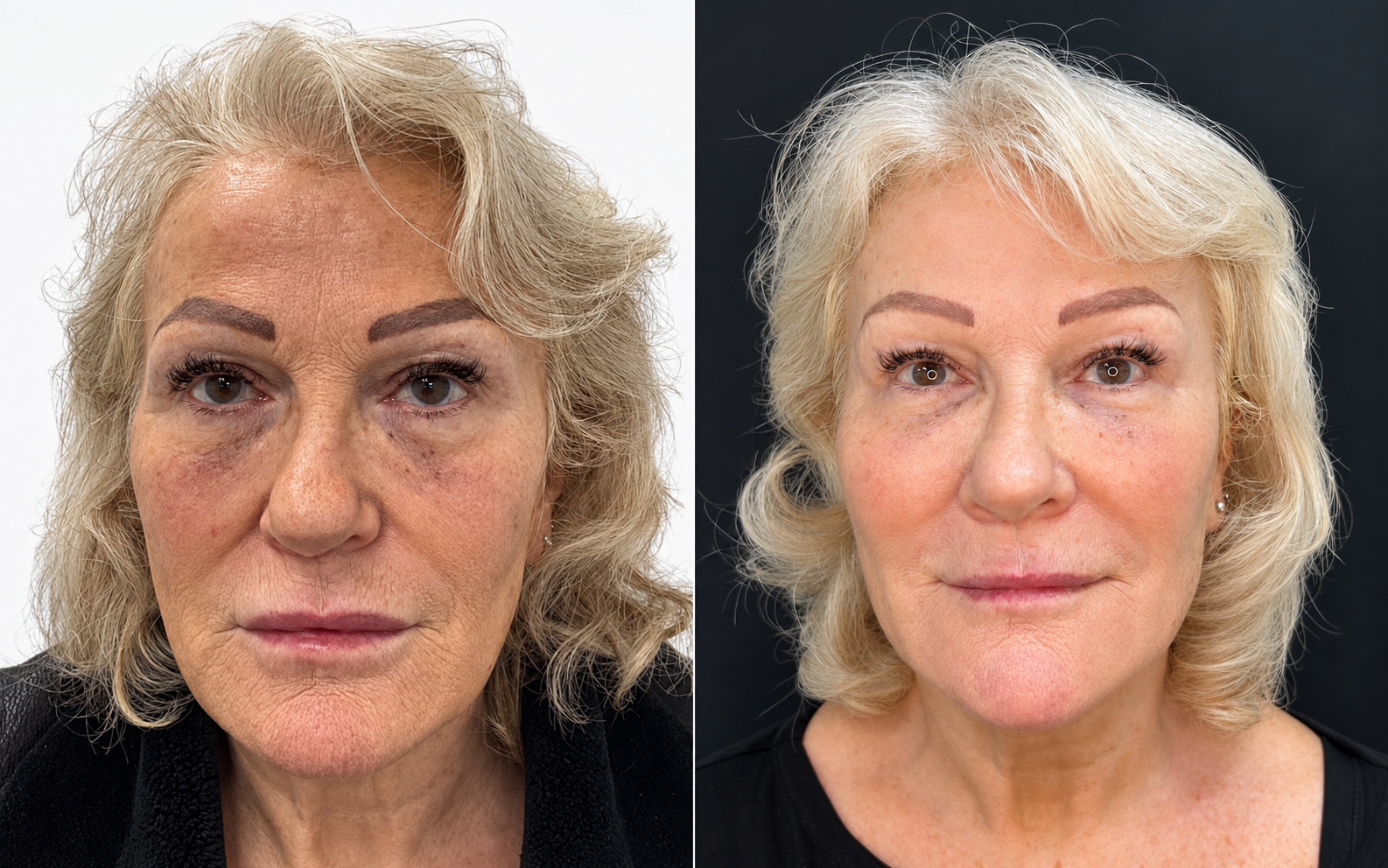 Before and after microneedling, front view: skin before treatment on the left and after treatment on the right