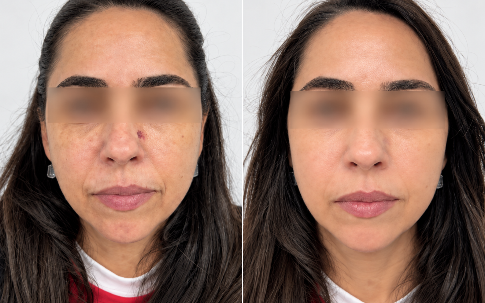 Before and after Sculptra, front view with the eyes blurred for privacy: before treatment on the left and after treatment on the right