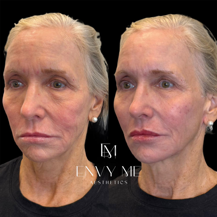 Before and after of full face filler rejuvenation