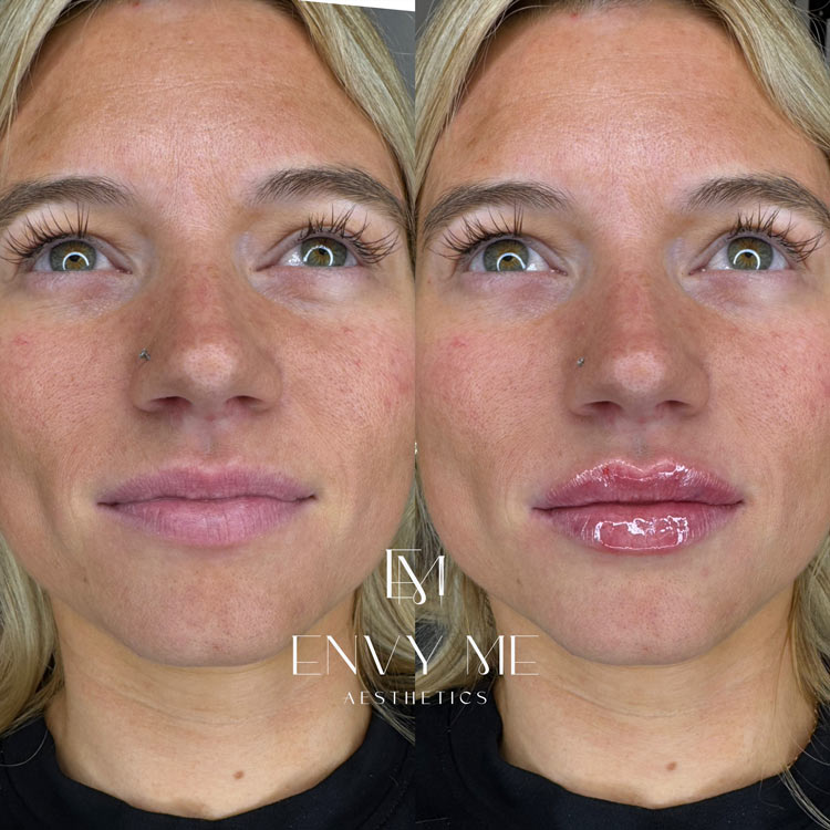 Before and after of a lip filler treatment